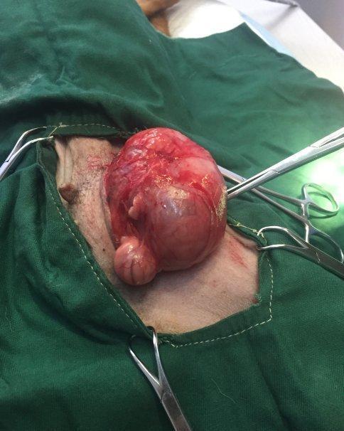 疝气手术可以吃瓜吗